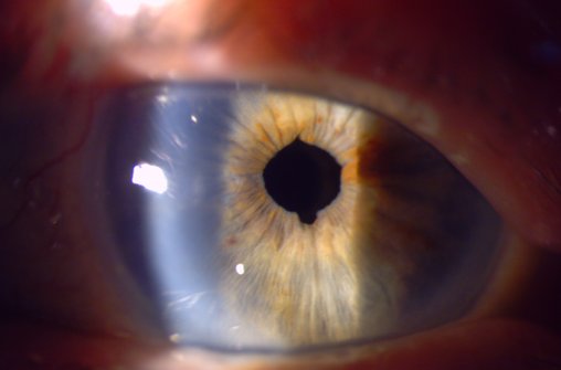 Patient med pseudoexfoliation (PEX) , bild efter kataraktkirurgi. I detta fall var pupillen så liten och svår att vidga att det behövdes lite mer kraft än vanligt, och speciella operationsinstrument för att kunna genomföra operationen med bra resultat. Spår av vidgningen ses kl 6 och 12 men har ingen påverkan på synen.
