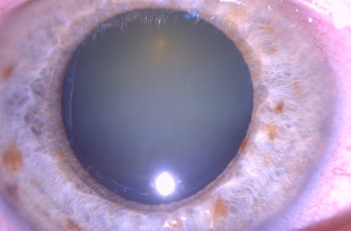 Patient med Psudoexfoliation (PEX) som ska opereras för katarakt (gråstarr) Katarakten är den ogenomskinliga lätt gulfärgade linsen. I normala fall skall det vara helt svart i detta område. PEX har gjort att den främre linskapseln är försvagad och söndersliten på två ställen, dels nära pupillkanten (kl 4-10) och dels (otydligare) cirkulärt nära mitten på pupillen. Som förväntat/befarat visade det sig under operationen att zonulatrådarna (som håller linsen på plats) var uttänjda och försvagade. Operationen gick bra. Denna typ av patient kräver en erfaren kirurg för att undvika komplikationer.