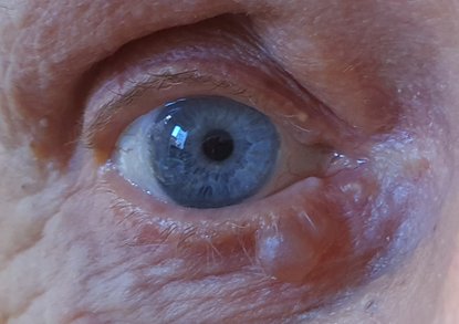 Cystor, xanthelasma, vagel, chalazion mm.  Kosmetisk kirurgi kring ögonen på StarrMedica Ögonklinik